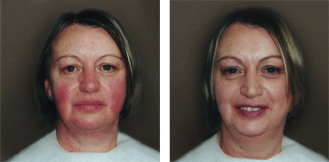 Spray Makeup on Cover Rosacea With Airbrush Makeup By Dinair
