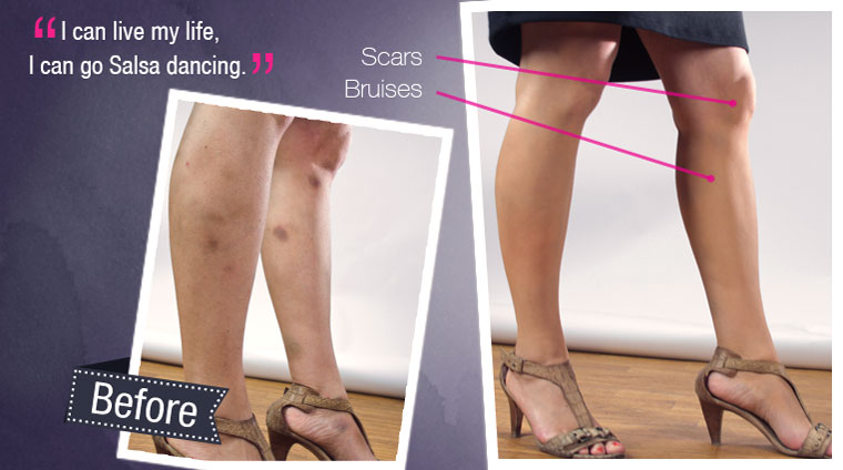 How To Use Makeup To Cover Scars On Legs - Makeup Vidalondon