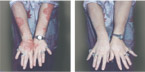 Cover Psoriasis with Makeup
