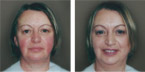Cover Rosacea with Makeup