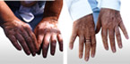 Cover Vitiligo with Makeup